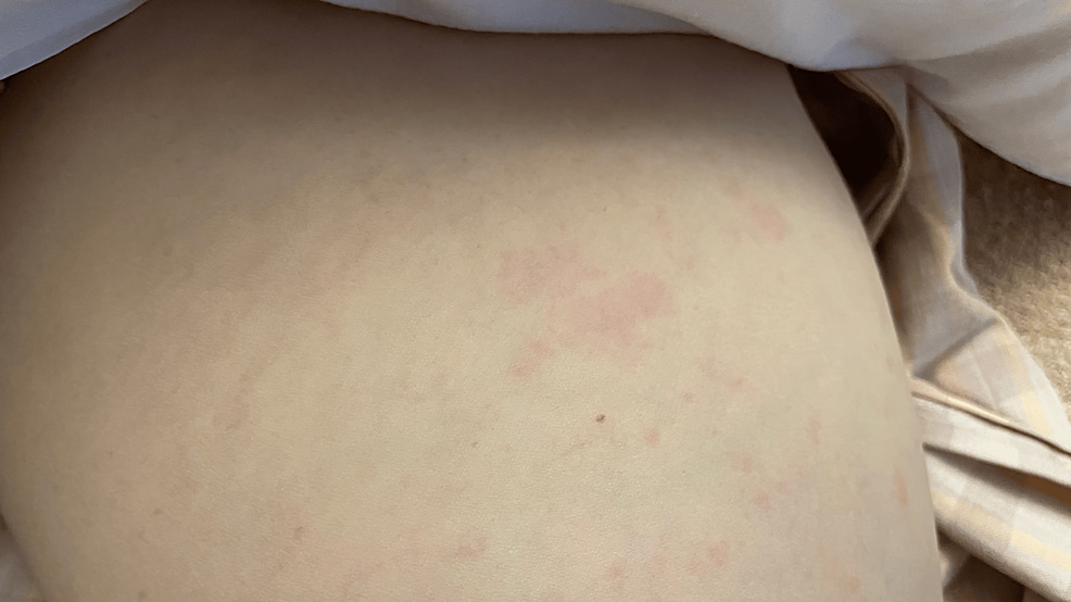 Acute Onset Rheumatoid Vasculitis With Polyarthritis and Erythema A