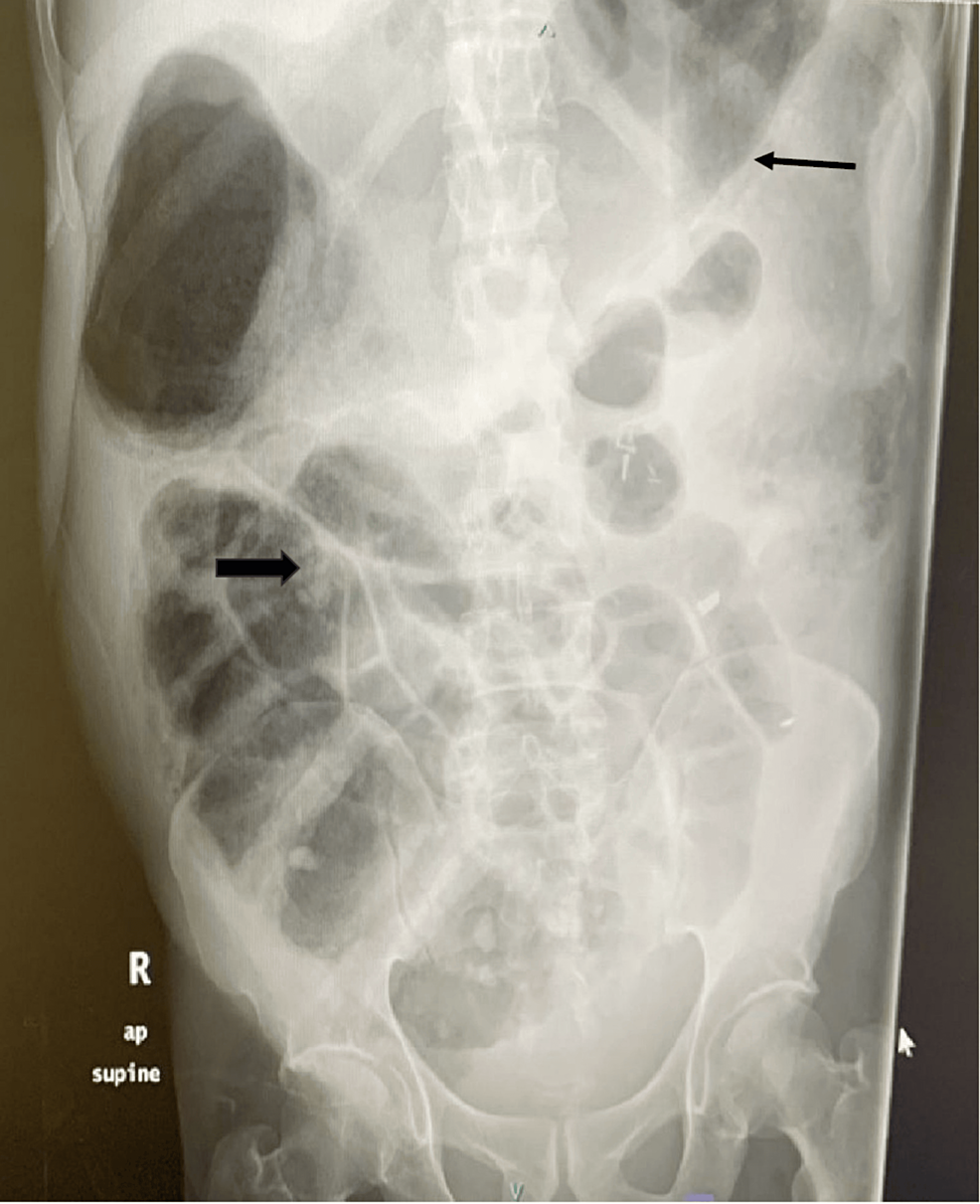 Cureus A Novel Technique Using Ryle's Tube for Colonic