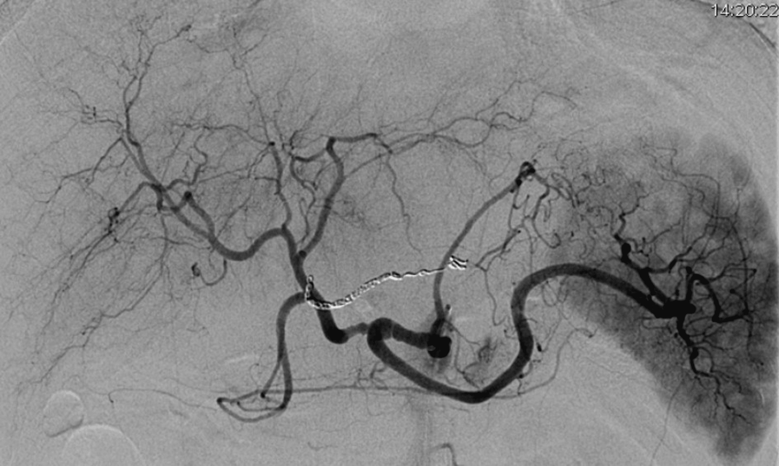 Cureus Gastric Artery Injury Due to Blunt Abdominal Trauma