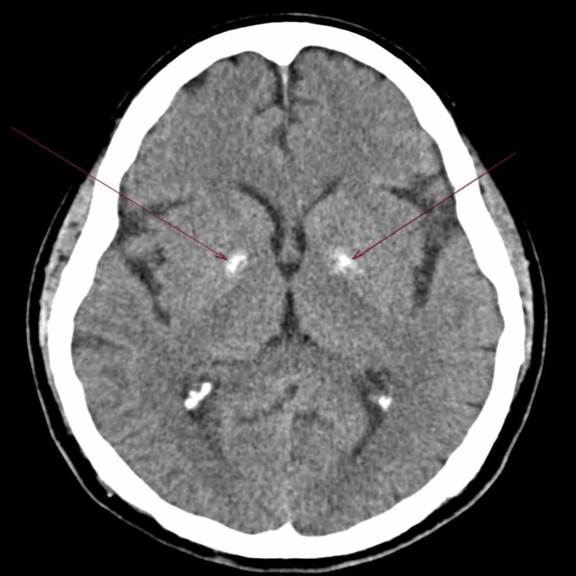 Cureus Idiopathic Basal Ganglia Calcification Fahr’s Syndrome, a