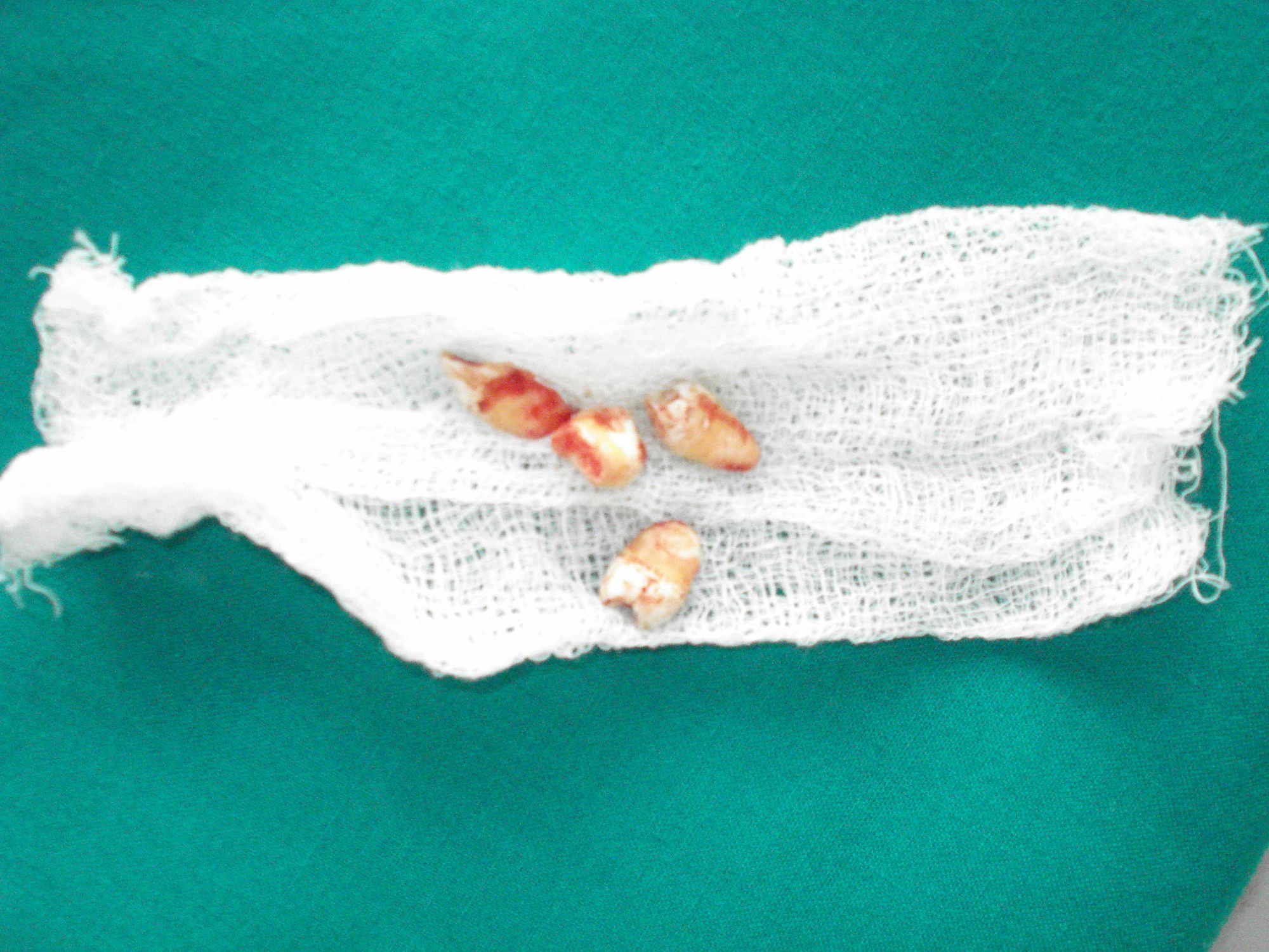 Cureus Idiopathic Basal Ganglia Calcification Fahr’s Syndrome, a