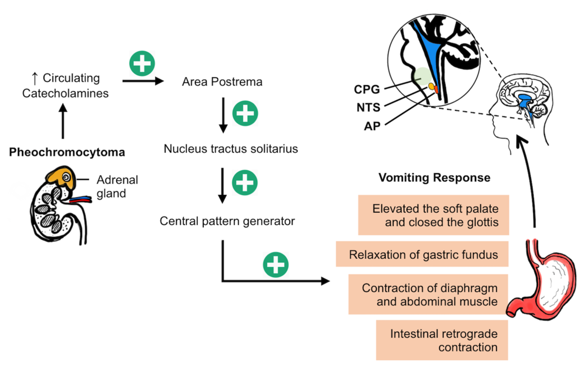 Cureus Light Intensity Activity Related Nausea An Unusual Presentation Of Pheochromocytoma