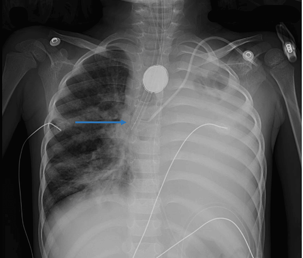 Cureus Unexpected Presentation of Tracheoesophageal Fistula During Intubation in a Pediatric