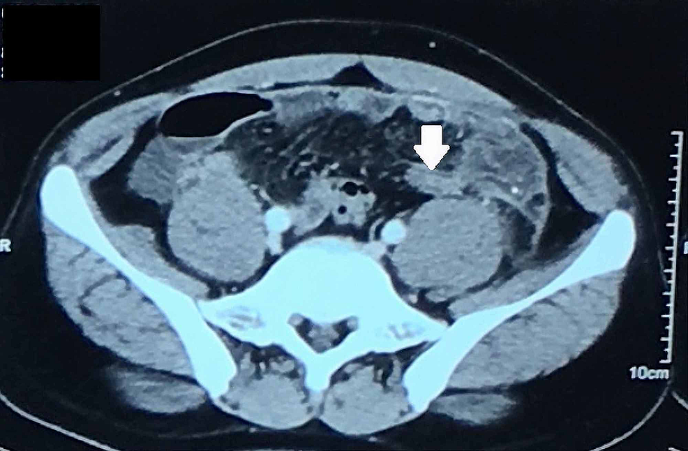 Cureus | A Case Report on Left-sided Appendicitis with Intestinal ...