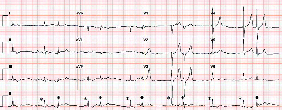 Cureus | Hyperkalemia Presenting as Sinus Bradycardia, Junctional ...