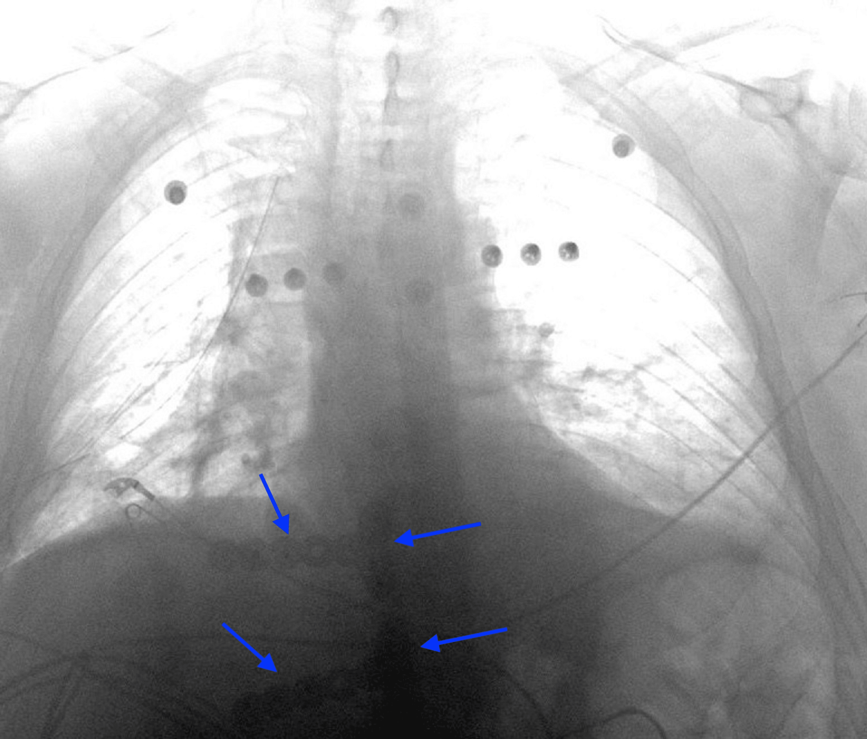 Management of a Flail Chest Caused by Multiple Costosternal Fractures A Case Report Cureus