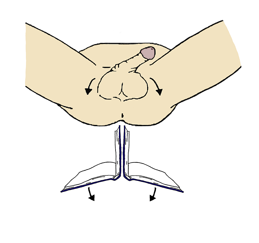 Manual-detorsion-maneuver-for-testicular-torsion.-With-the-physician-facing-the-patient,-the-right-testis-is-rotated-clockwise-while-the-left-is-rotated-counterclockwise.-This-is-referred-to-as-the-"open-book"-maneuver,-as-the-movement-is-akin-to-opening-a-book.-(Artwork-by-Dr.-Amanda-Webb)