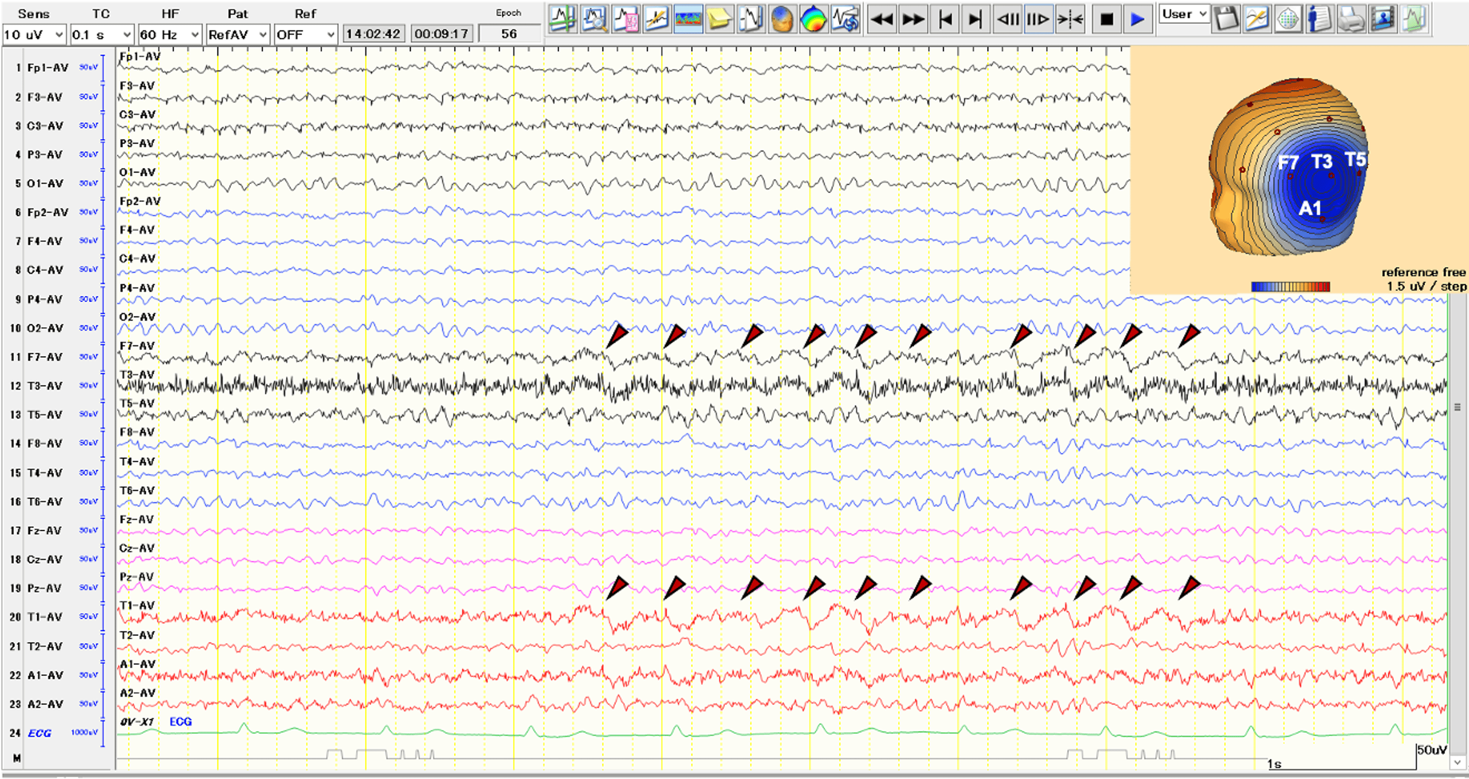 Cureus Attacks With Urinary Incontinence Without Convulsions