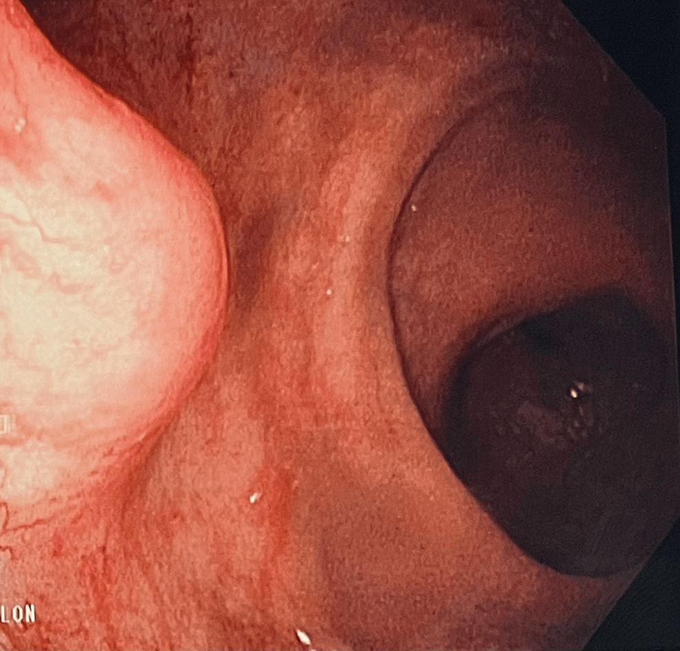 A Rare Case of Primary Extra-Nodal Marginal Zone Lymphoma of Mucosa-Associated Lymphoid Tissue (MALT) in the Rectum