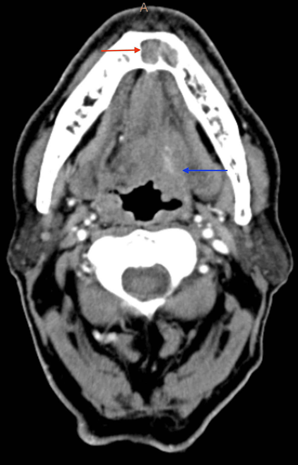 cureus-base-of-tongue-squamous-cell-carcinoma-with-metastasis-to-the