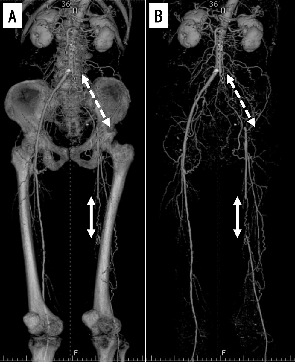 Successful Removal of an Entrapped Stent Delivery Catheter Using Two ...