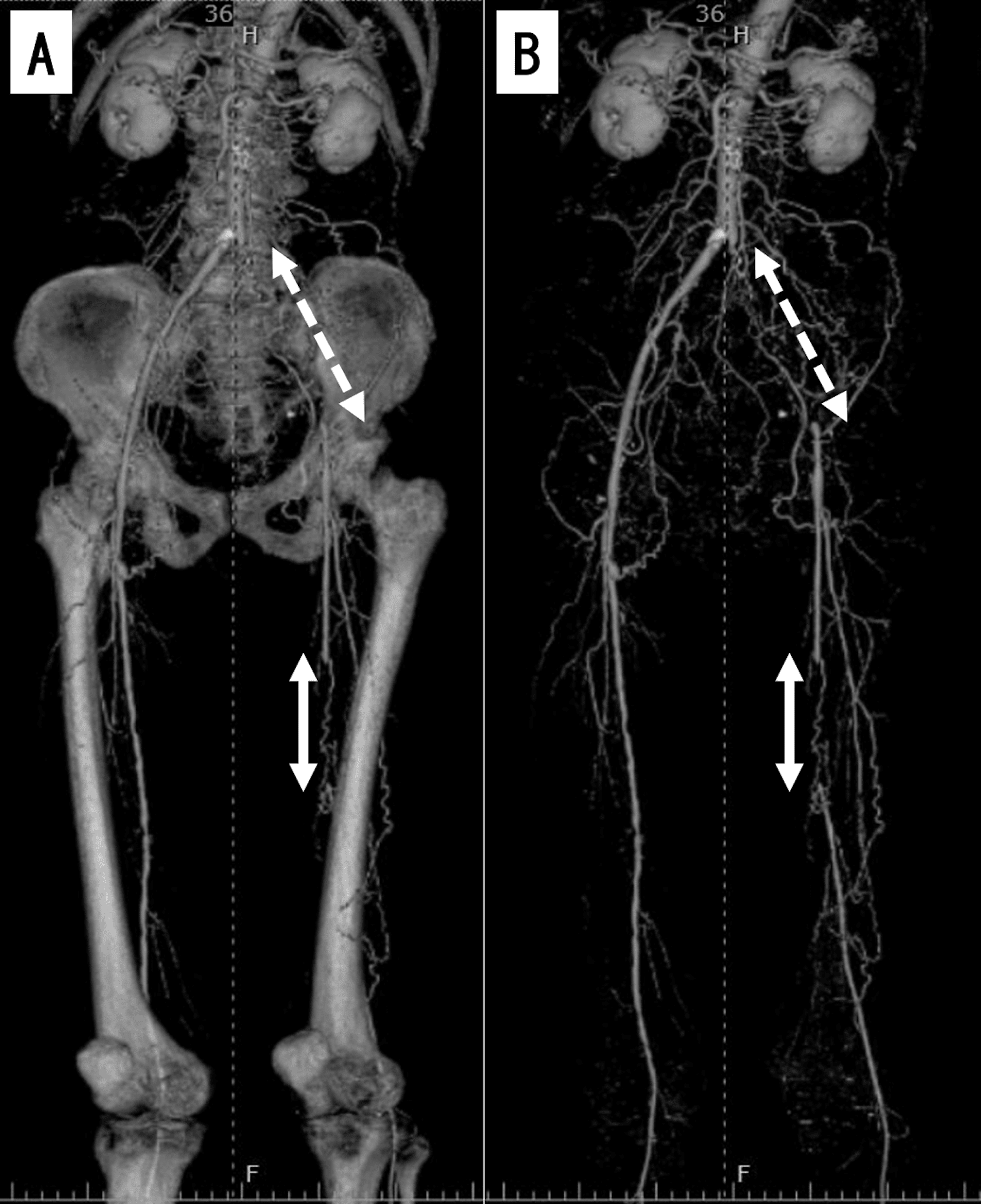 Successful Removal of an Entrapped Stent Delivery Catheter Using Two ...