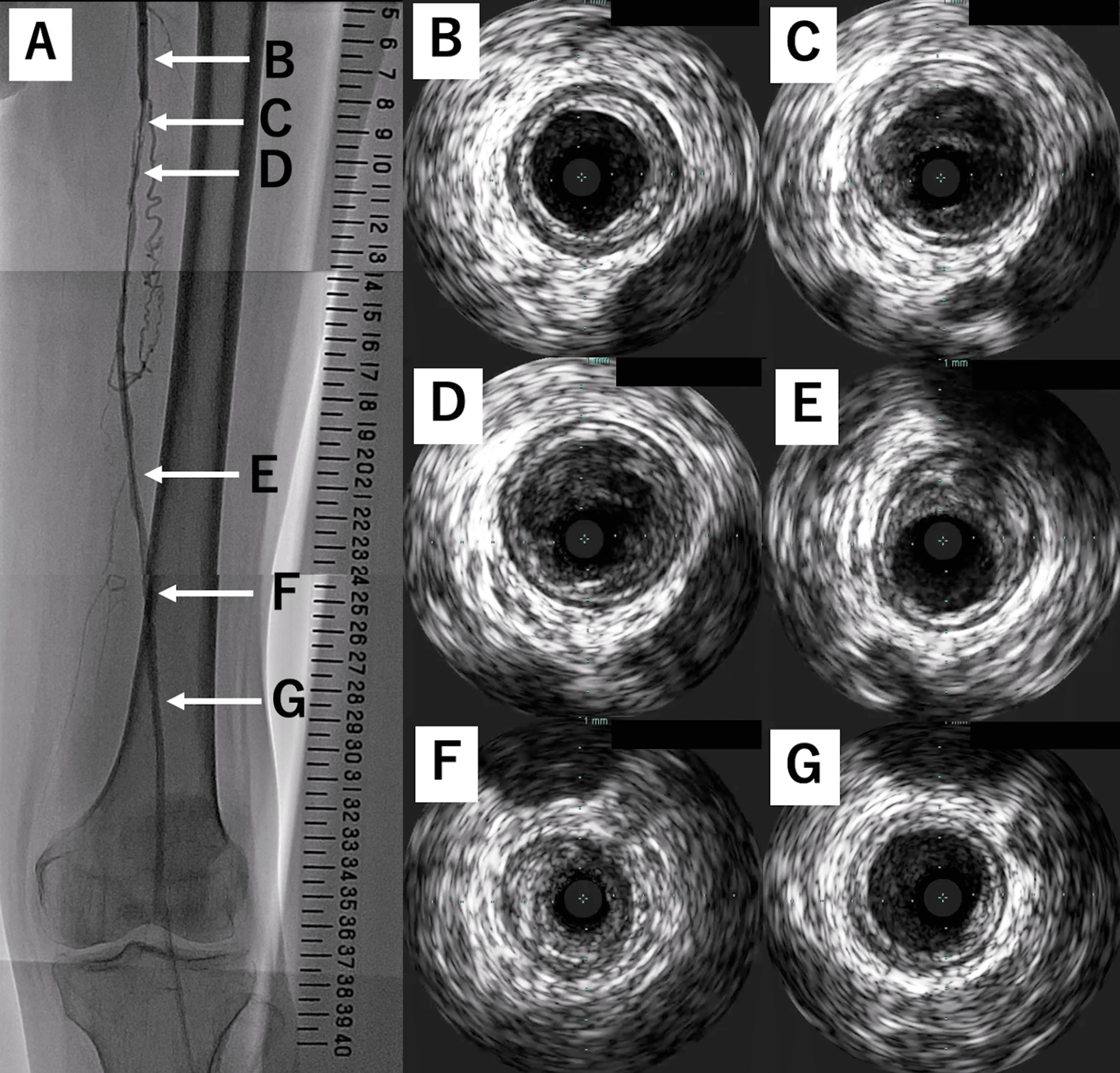 Successful Removal of an Entrapped Stent Delivery Catheter Using Two ...