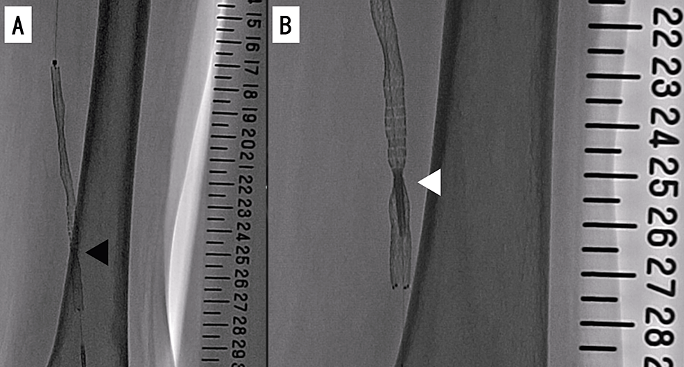 Successful Removal Of An Entrapped Stent Delivery Catheter Using Two 