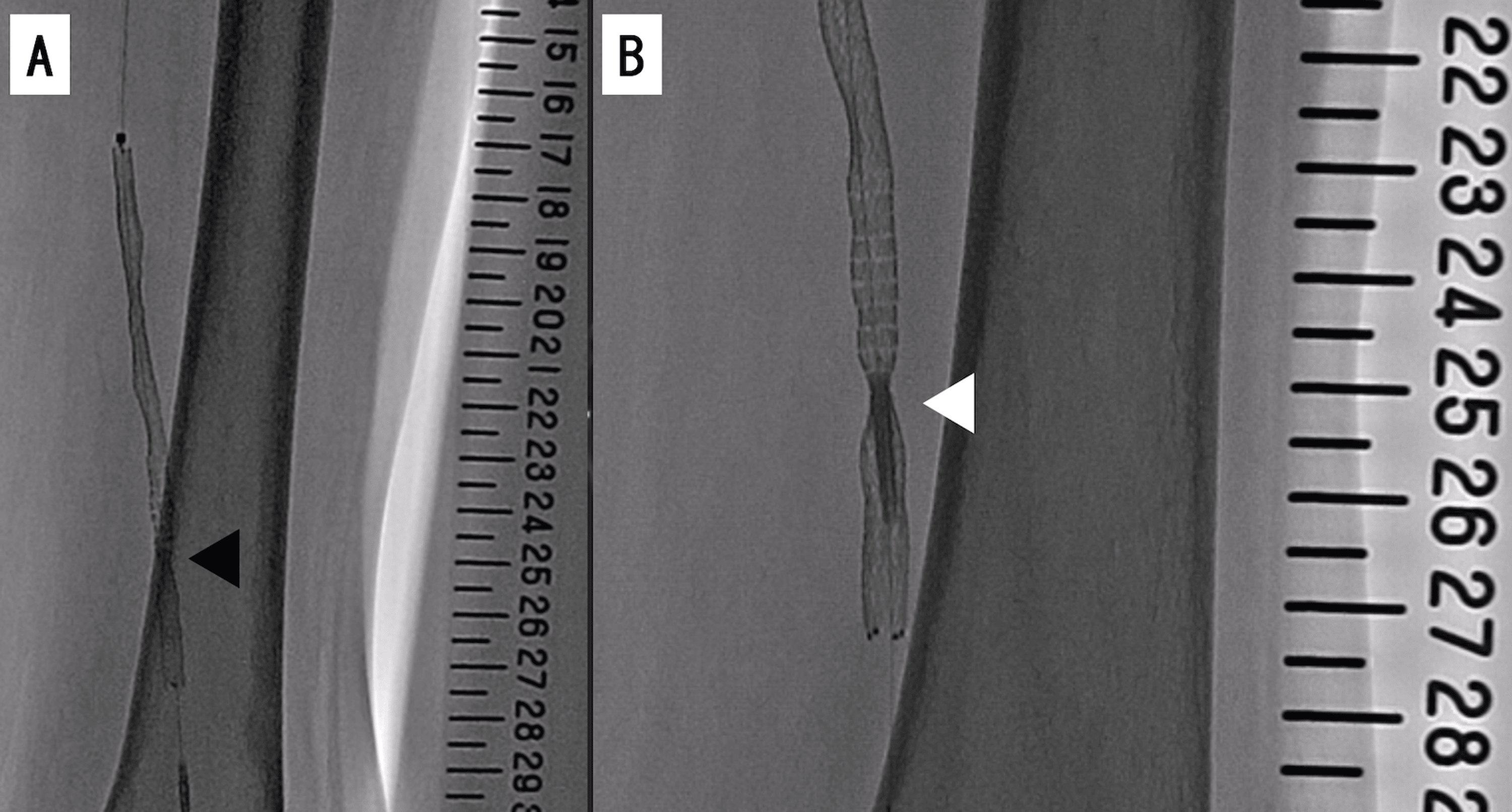 Successful Removal of an Entrapped Stent Delivery Catheter Using Two ...