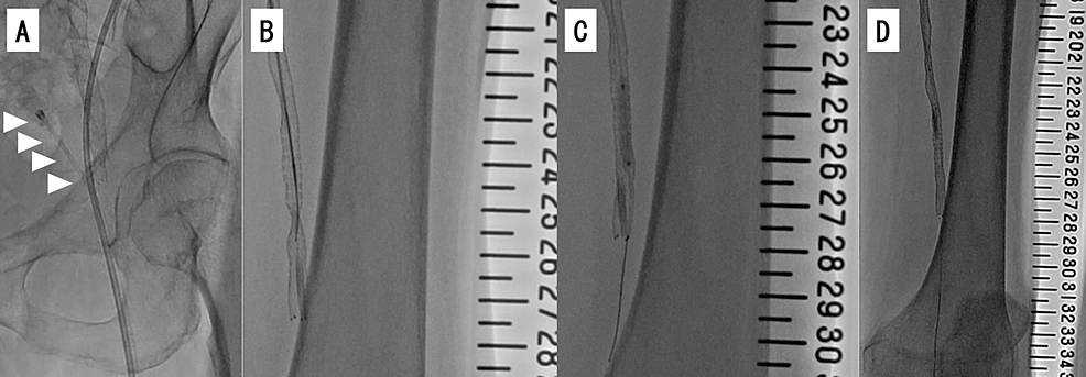 Successful Removal of an Entrapped Stent Delivery Catheter Using Two ...