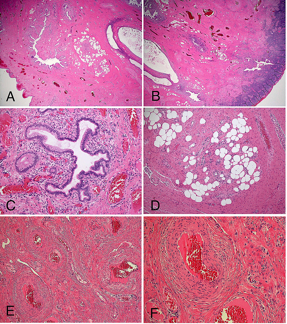 cureus-benign-endocervical-polyp-with-heterologous-elements-in-a-42