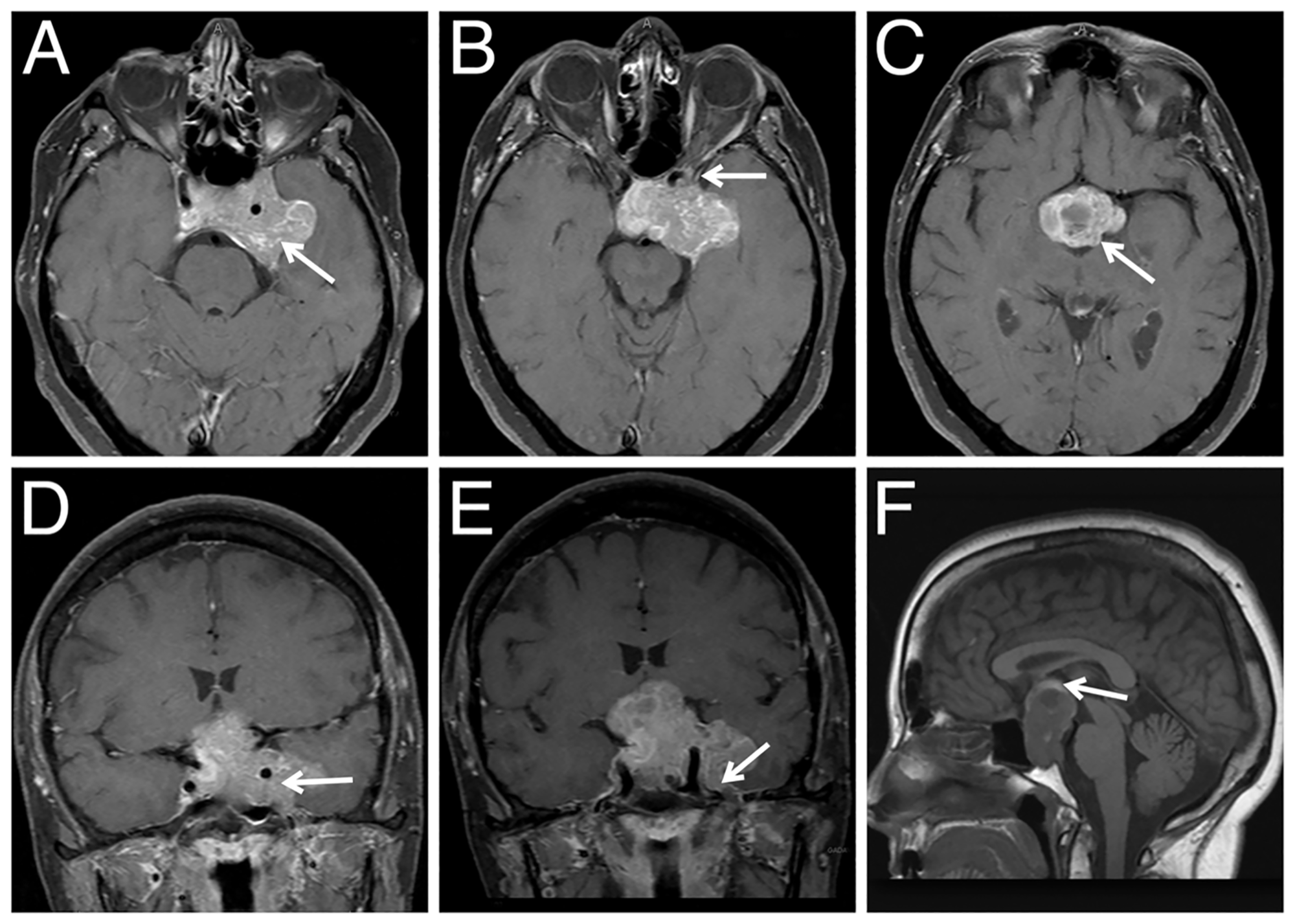 Cureus Resection Of Pituitary Tumor With Lateral Extension To The Temporal Fossa The 8851