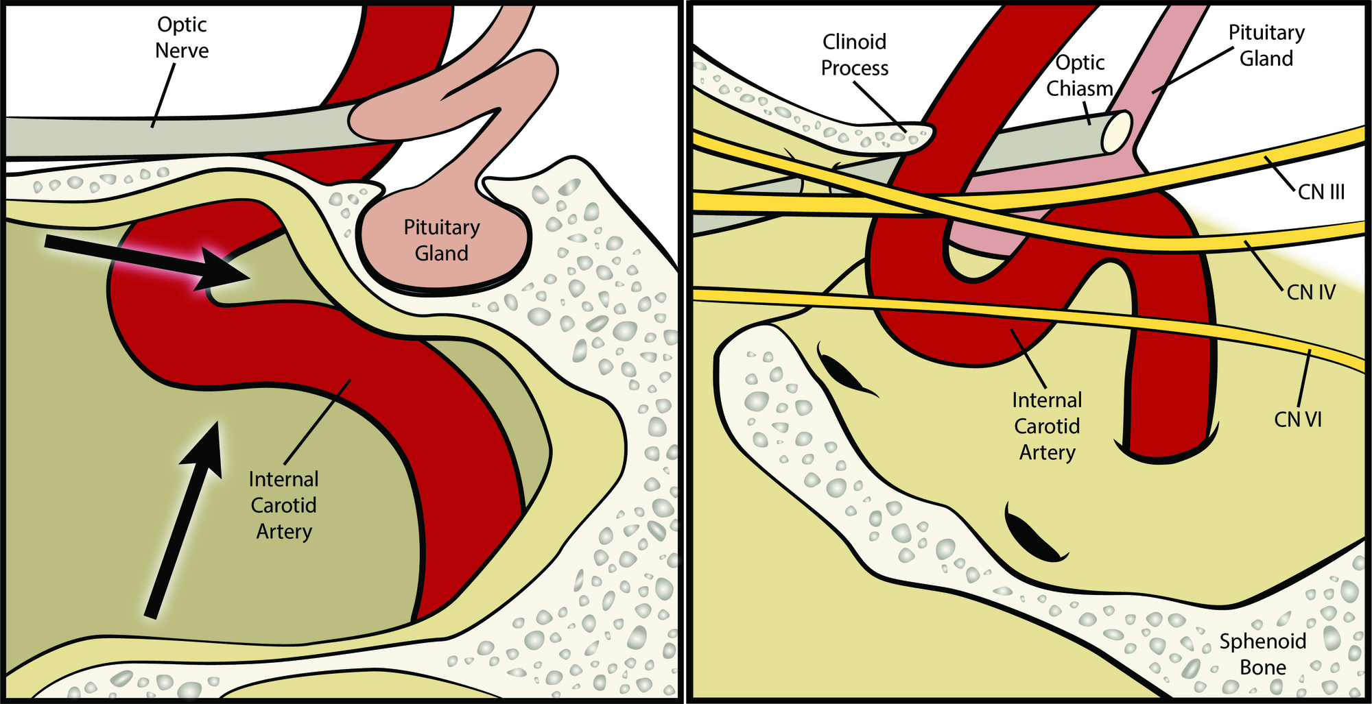 Cureus Resection Of Pituitary Tumor With Lateral Extension To The Temporal Fossa The Toothpaste Extrusion Technique