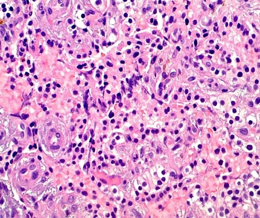 Cureus A Rare Case Of Severe Hypercalcemia Secondary To Atypical Parathyroid Cystic Adenoma 2870