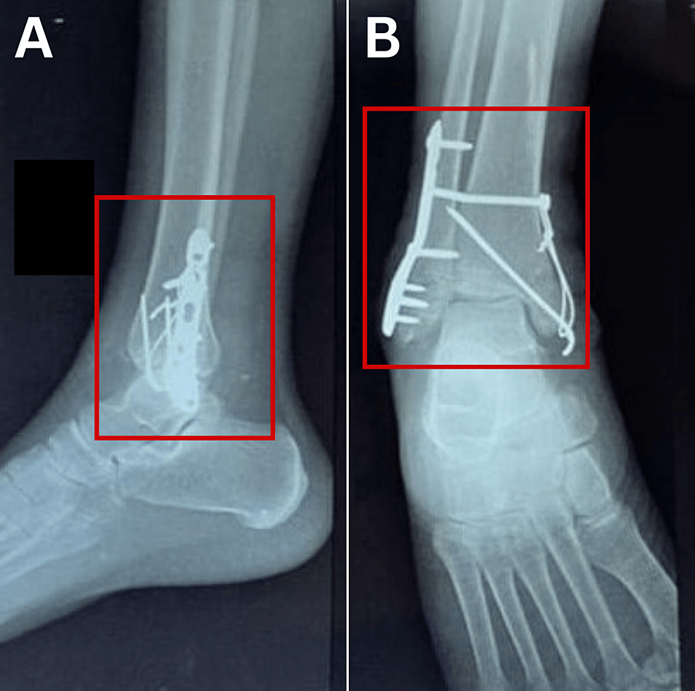 Cureus, Comprehensive Physiotherapy Protocol in Post-operative Case of  Trimalleolar Fracture: A Case Report