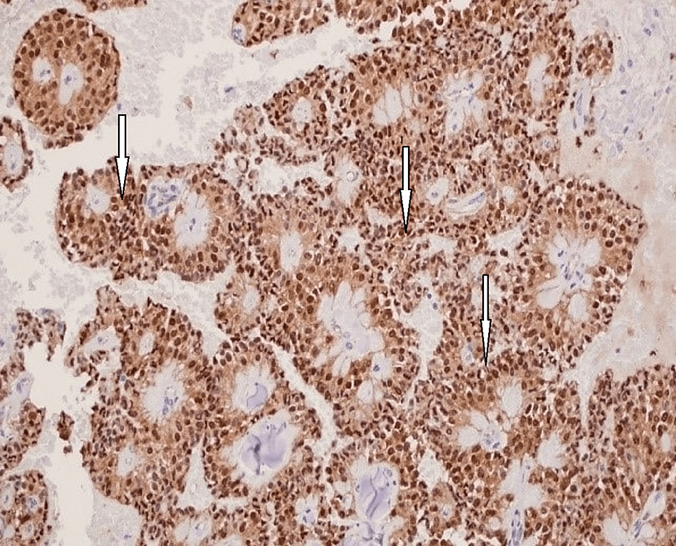 Cureus | Solid Pseudopapillary Neoplasm of the Pancreas: A ...