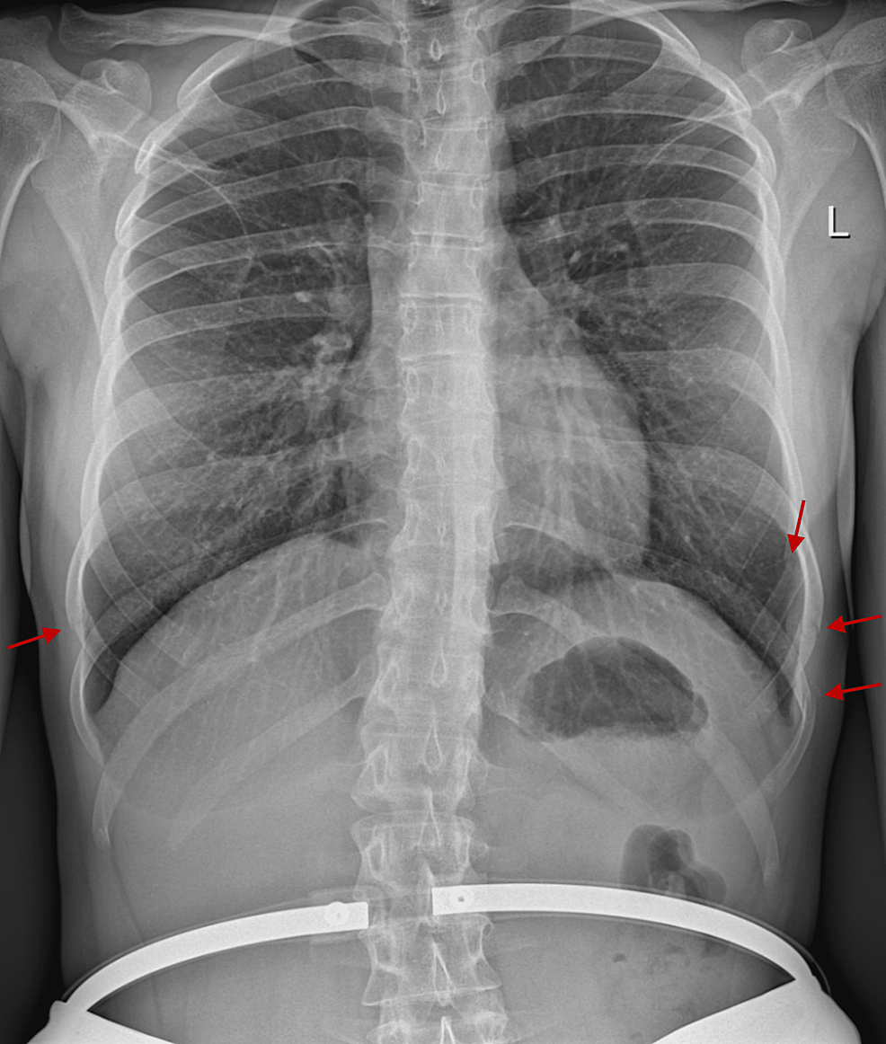 Cureus CoughInduced Multiple, Bilateral, Asymmetrical Rib Fractures