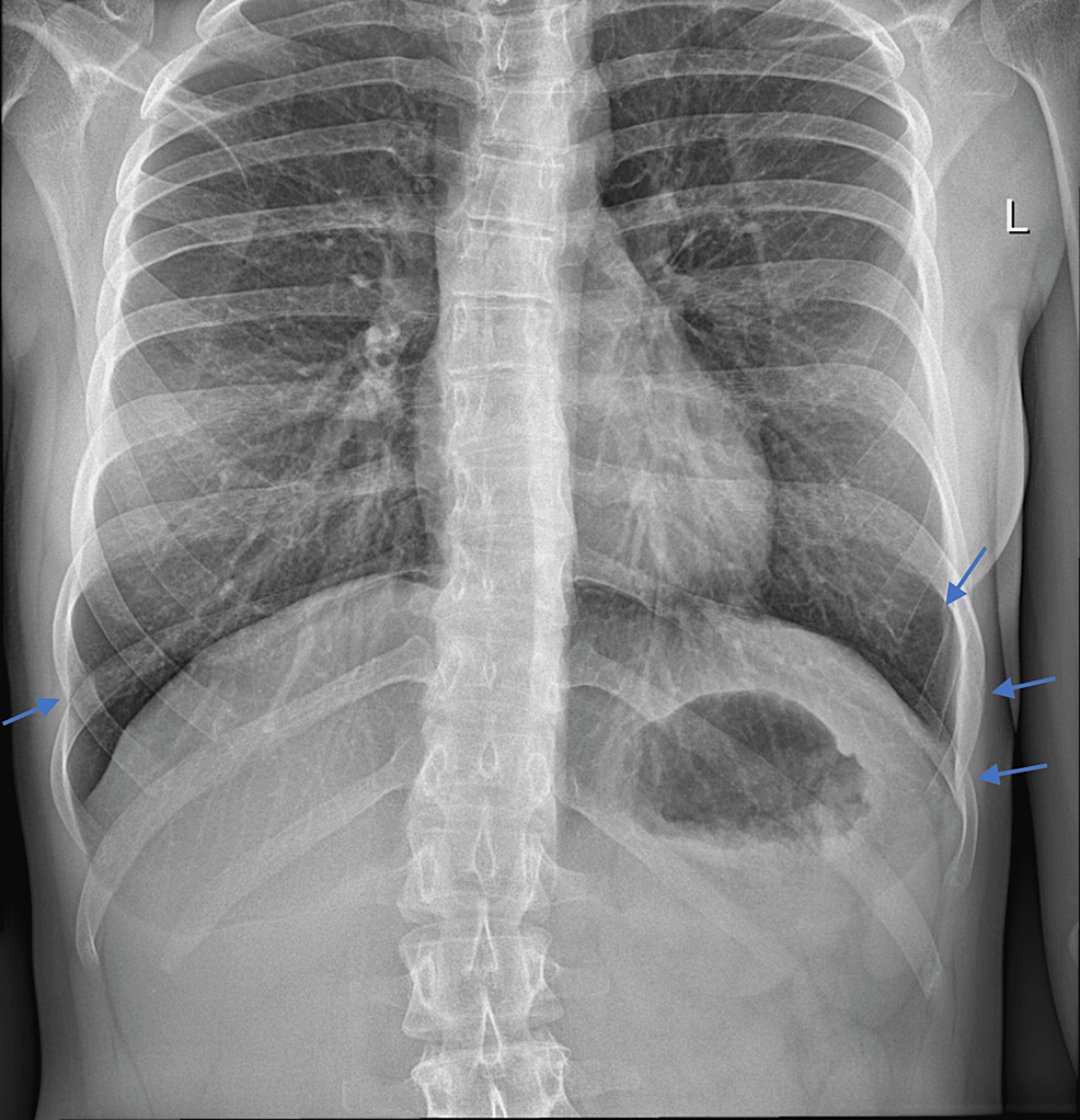 Cureus CoughInduced Multiple, Bilateral, Asymmetrical Rib Fractures