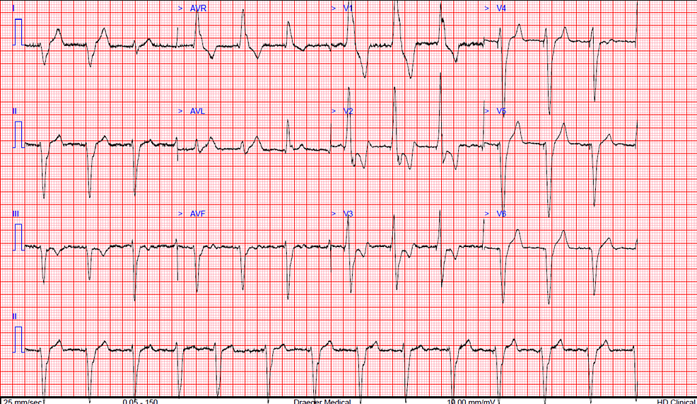 Unintentional Implantation Of A Permanent Pacemaker Lead Across A 