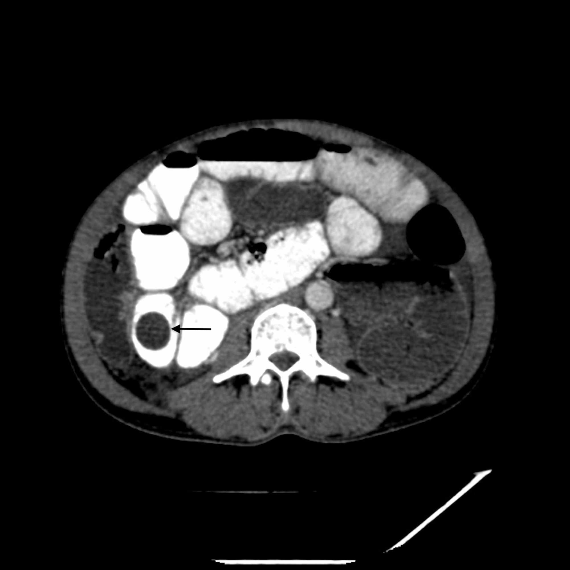 Cureus | Fistulization of Peritoneal Hydatid Cyst to the ...