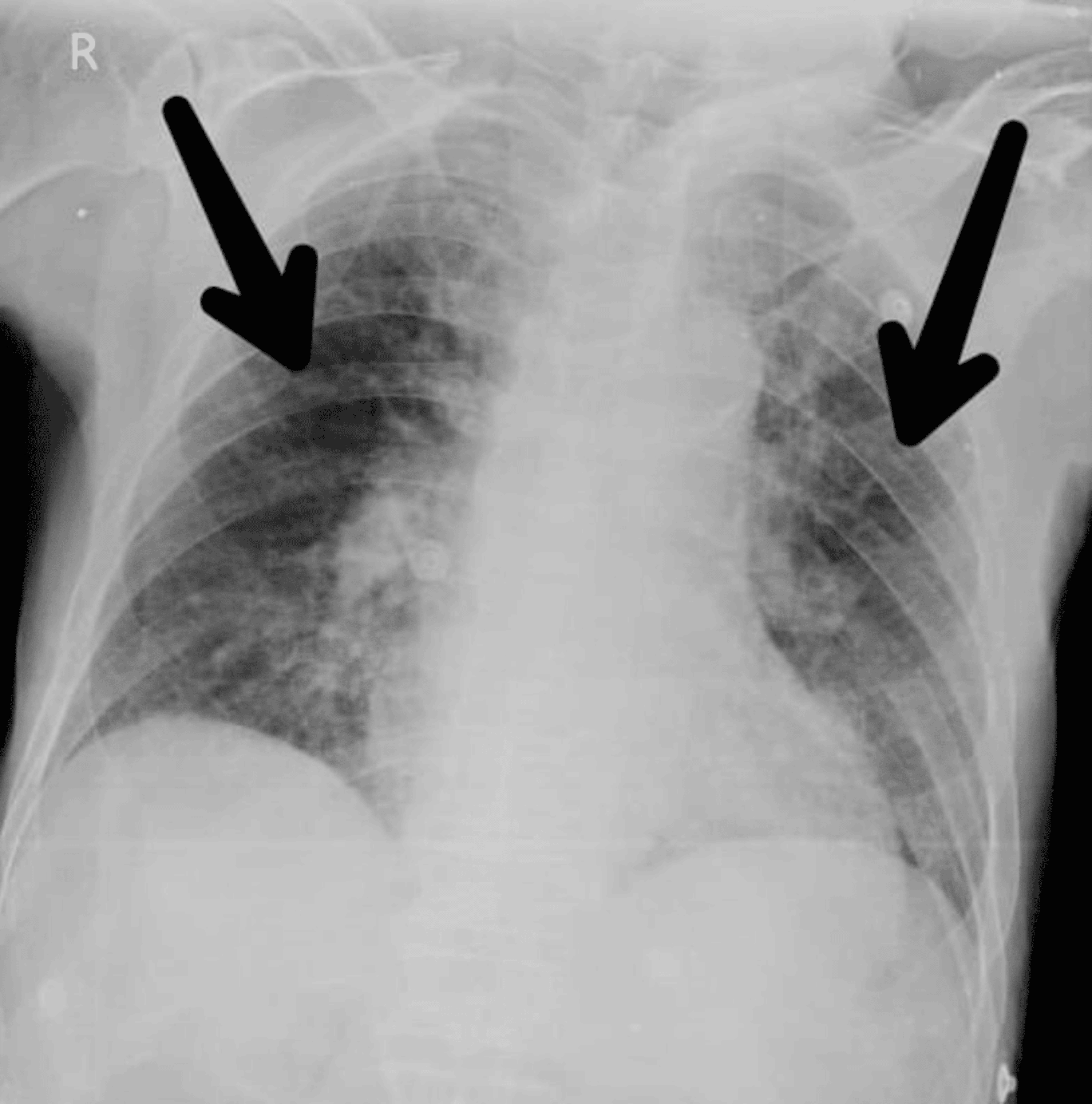 Physiotherapy Approach for Treating Bronchopneumonia A Case Report