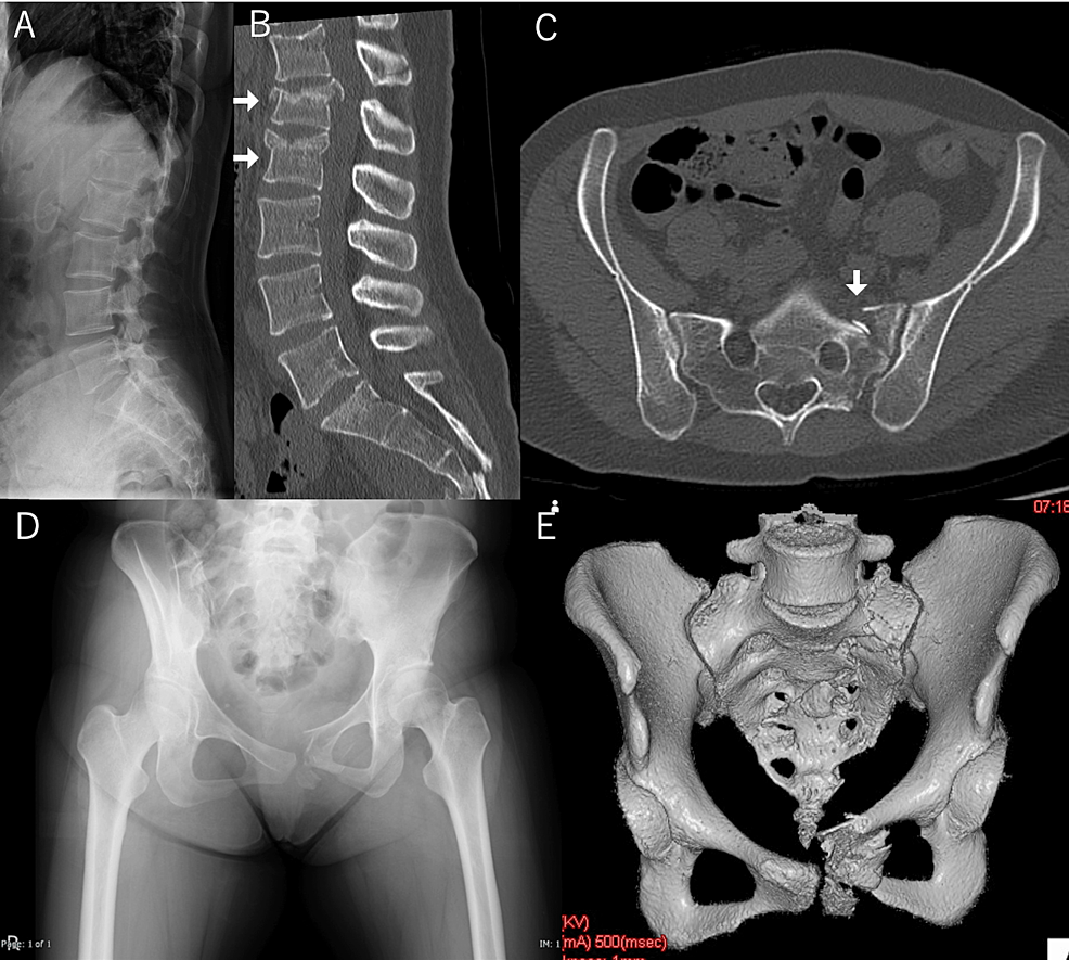 Osteoporotic Pelvic Fractures (02.02.2018)