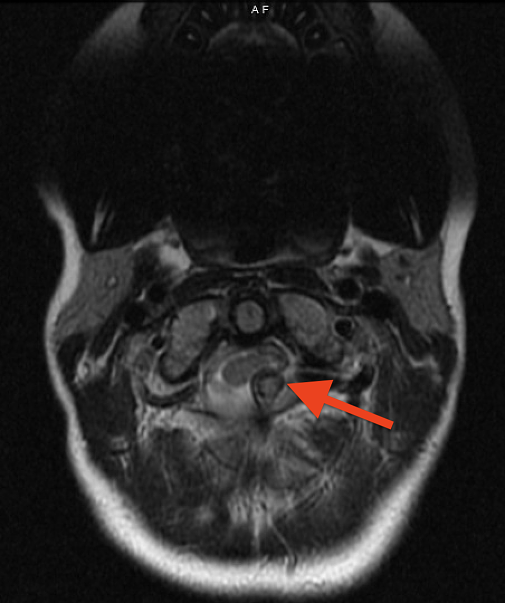 Hereditary multiple exostoses with spinal cord compression.