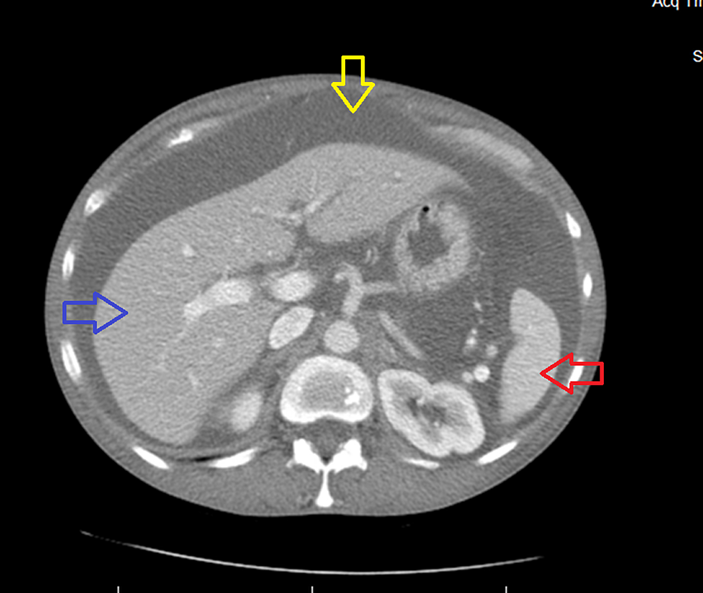 CT-of-the-abdomen-showing-ascites-(yellow-arrow),-normal-sized-liver-(blue-arrow)-and-spleen-(red-arrow)