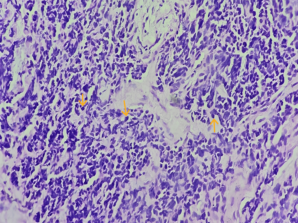 Small Cell Non Keratinizing Neuroendocrine Carcinoma Involving The Larynx And The Base Of The