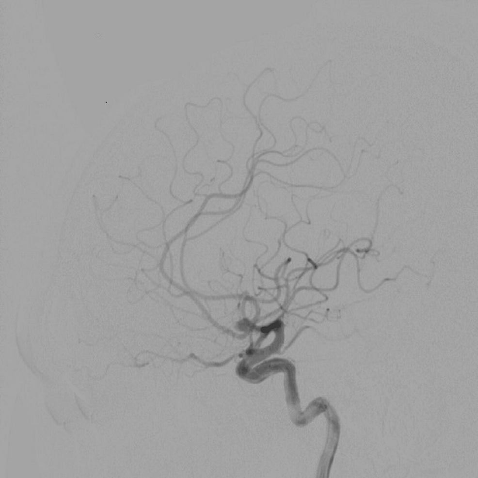 Intracranial aneurysm: a rare neurological finding in ankylosing spondylitis