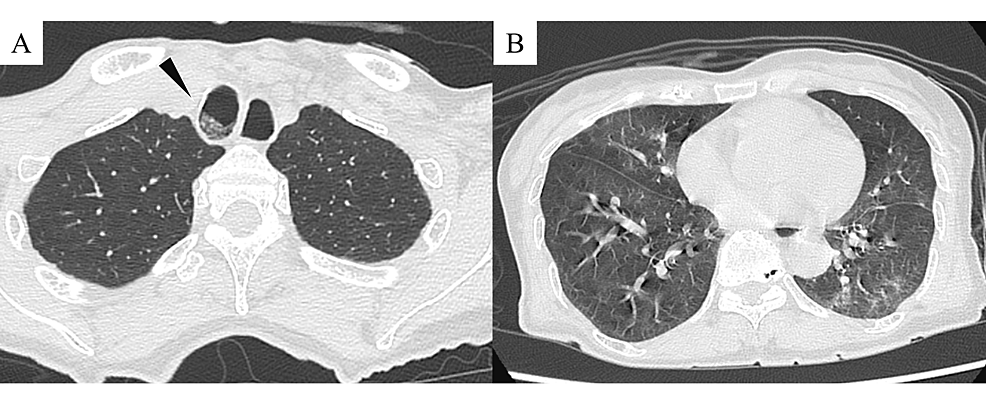 Cureus | recurrent transient hypoxemia in a schizophrenic patient