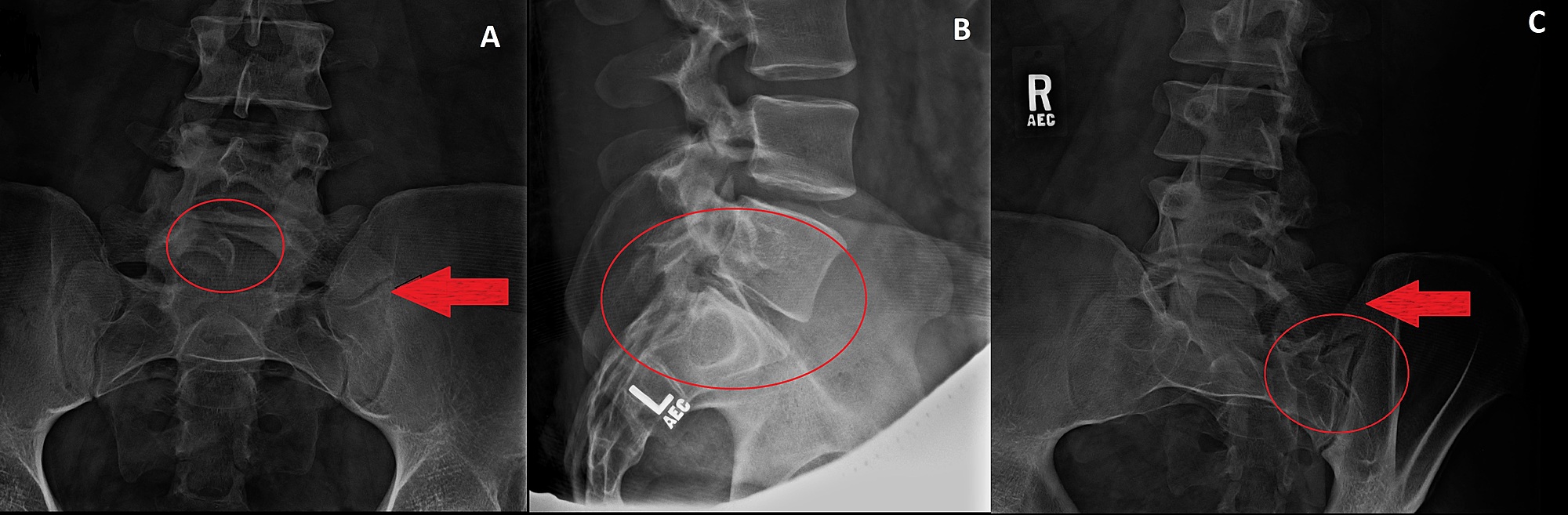 Cureus | Transitional Vertebra and Spina Bifida Occulta Related with