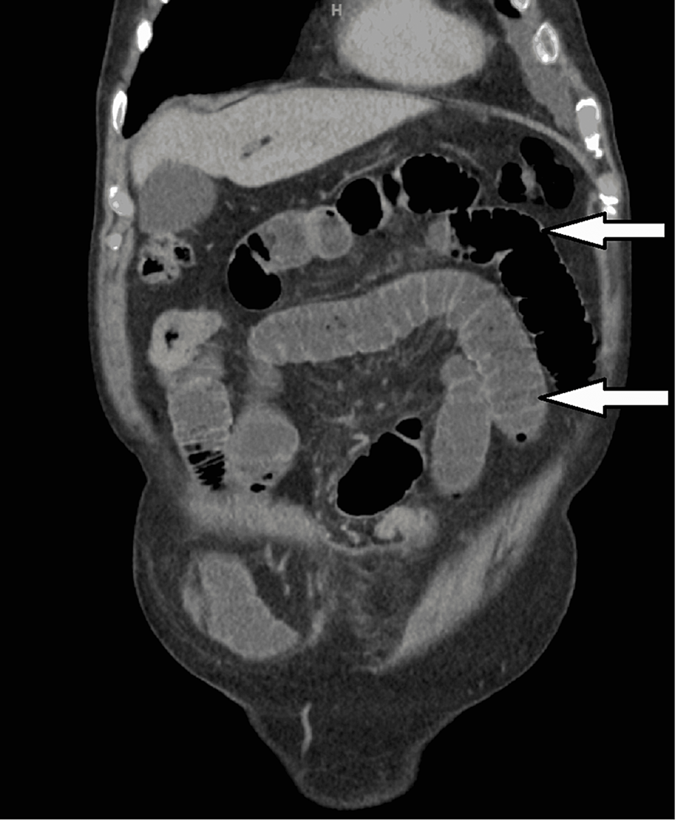 Intussusception in Incisional Hernia: A Case Report and Literature Review