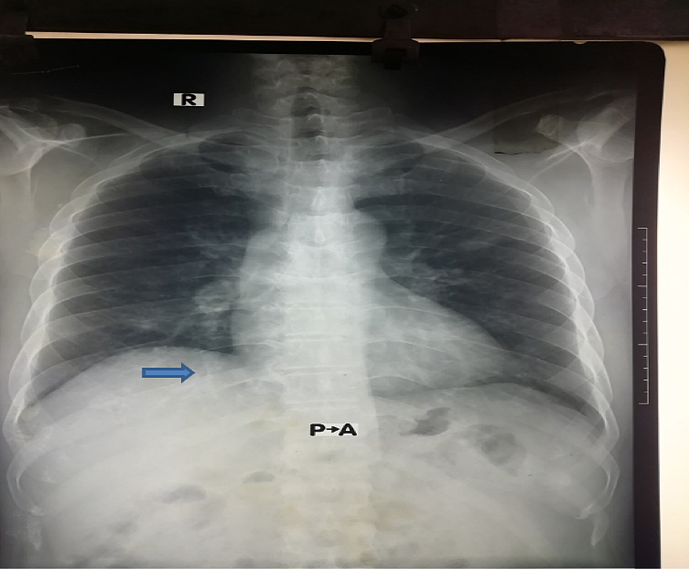 A Case of Granulomatosis with Polyangiitis (Wegener’s Granulomatosis ...