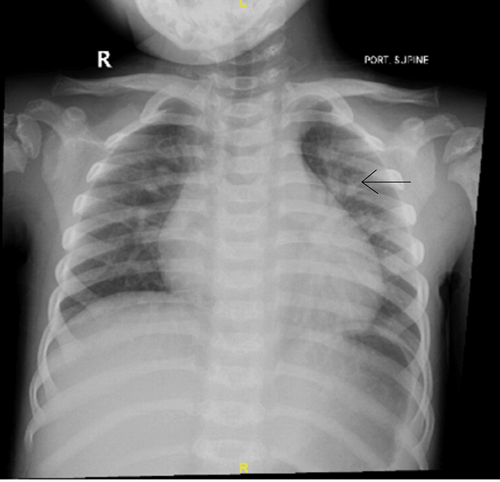 Cureus Spondyloenchondrodysplasia With Immune Dysregulation But cureus-spondyloenchondrodysplasia-with-immune-dysregulation-but