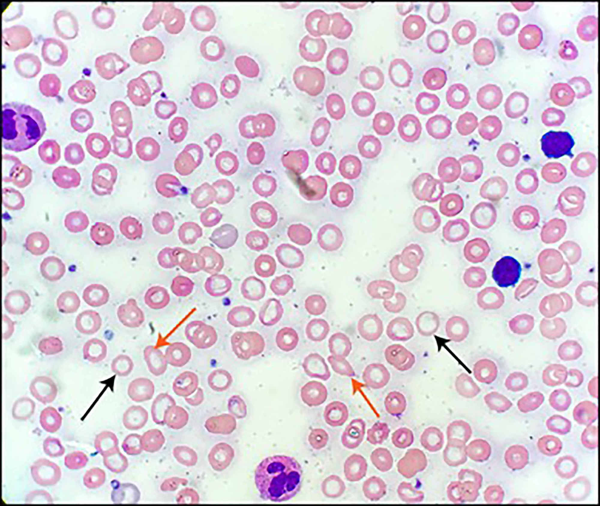Cureus Zinc Deficiencyinduced Hypogeusia in a Patient with