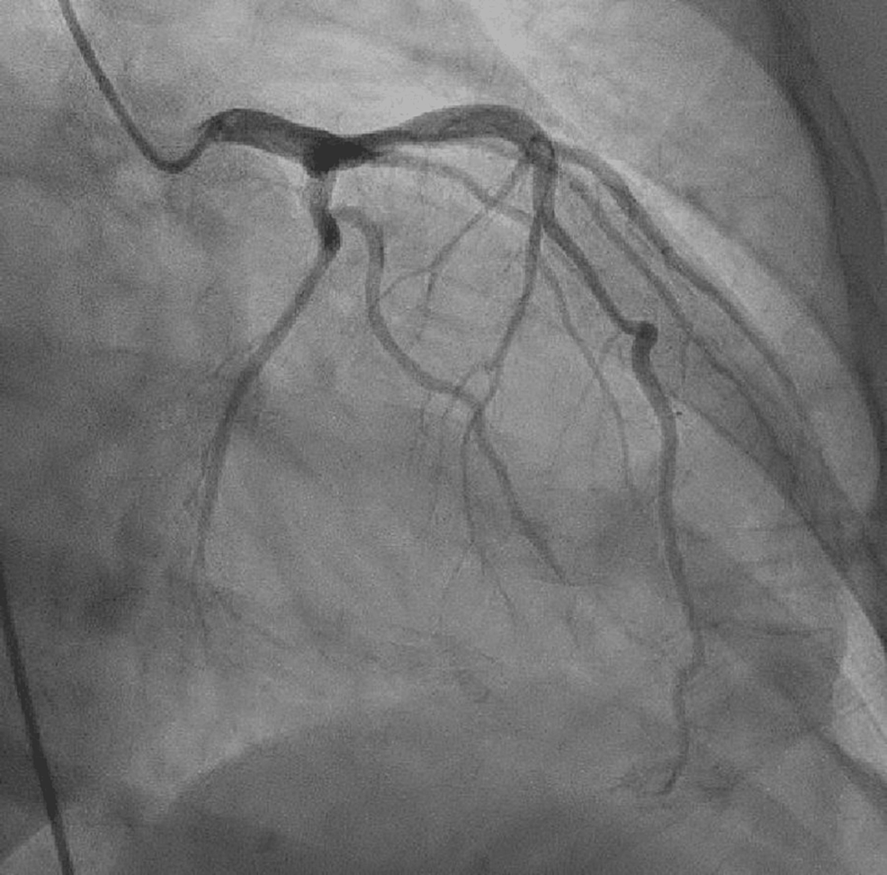 LightChain (AL) Cardiac Amyloidosis Presenting as Heart Failure With