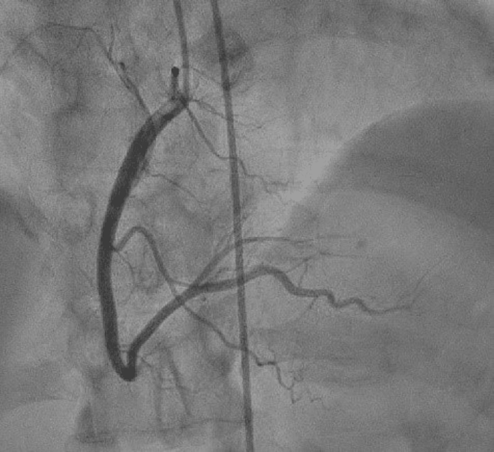 LightChain (AL) Cardiac Amyloidosis Presenting as Heart Failure With