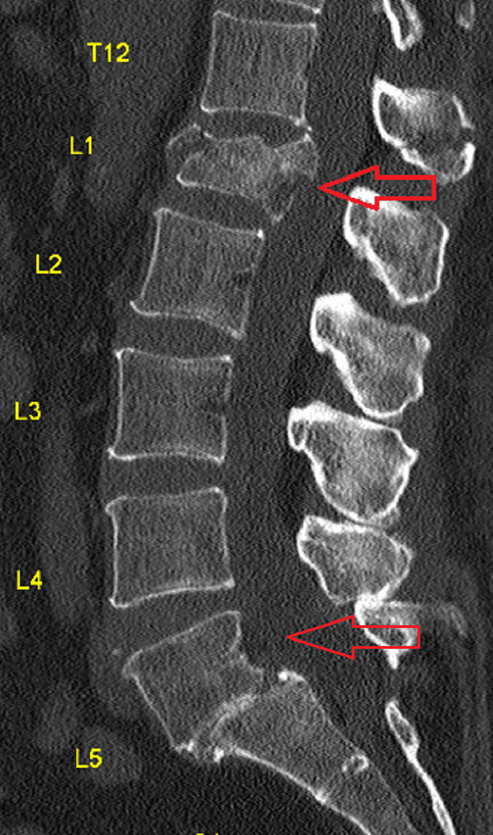 Acute and chronic vertebral compression fractures