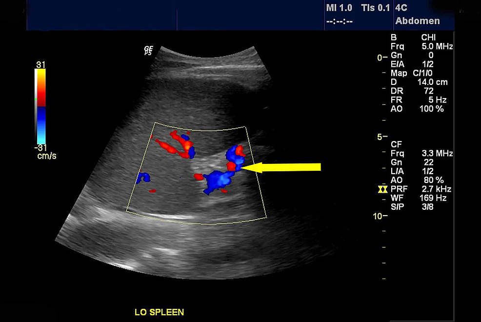 Splenic Vein Thrombosis Ultrasound