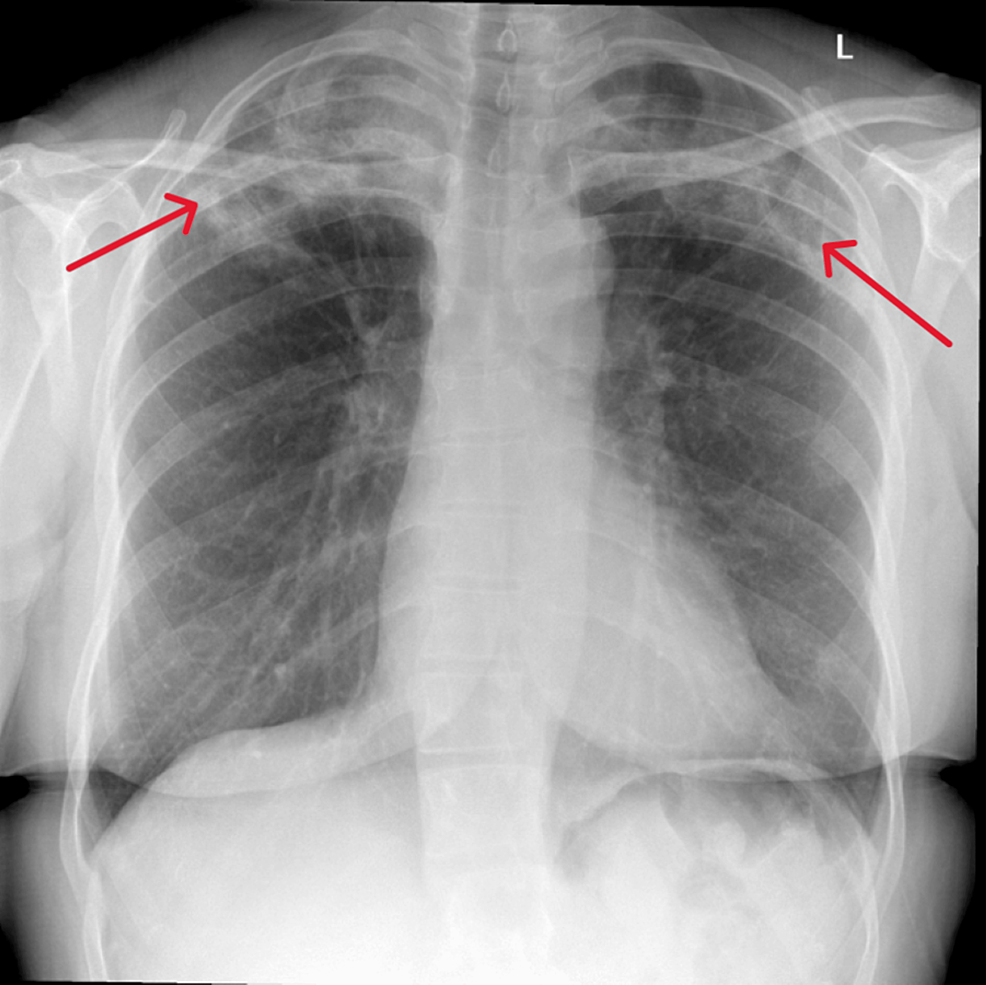 Chronic Eosinophilic Pneumonia Unraveling Recurrent Chest Infections