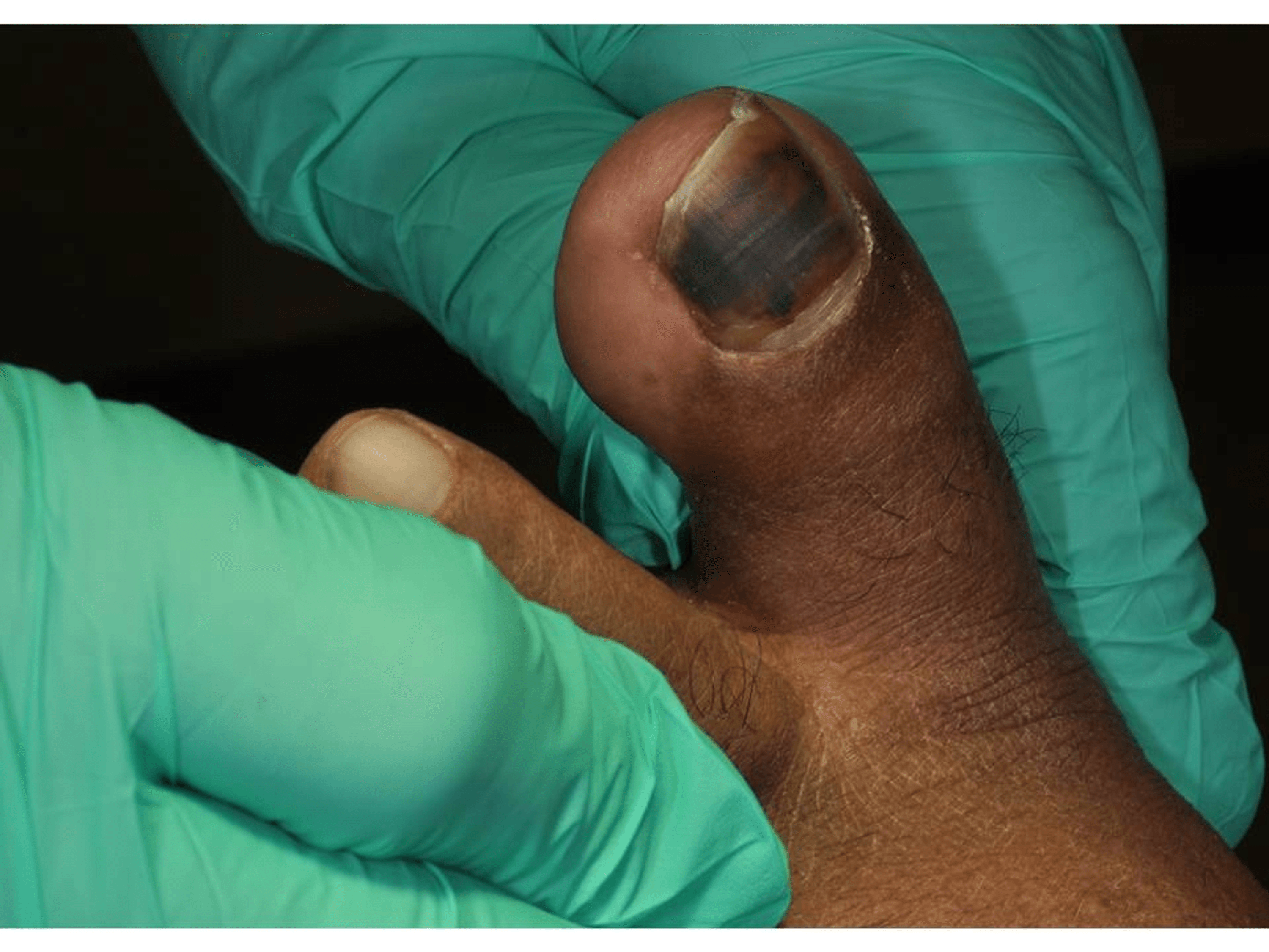 Cureus Subungual Hematoma