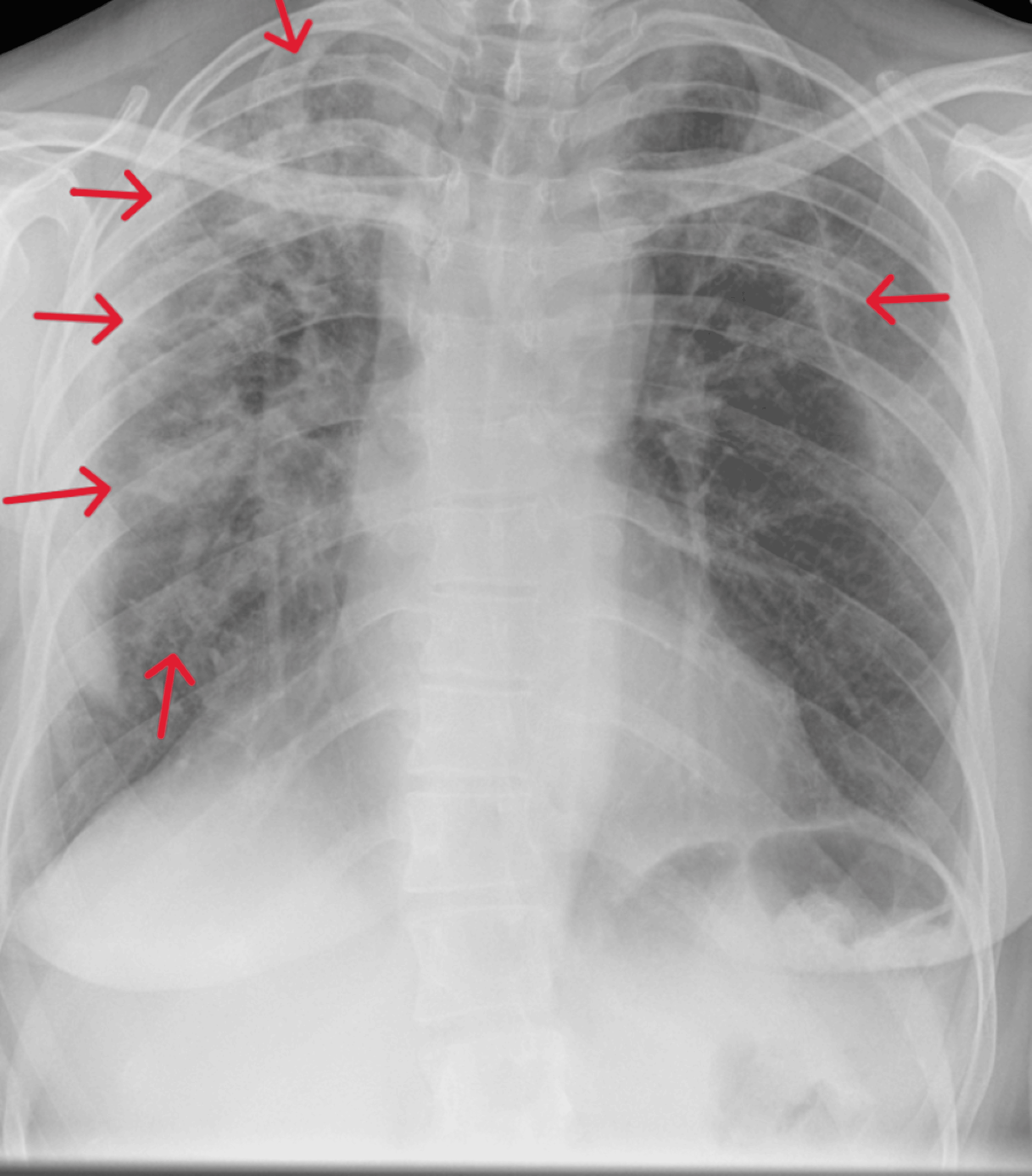 Cureus Chronic Eosinophilic Pneumonia Unraveling Recurrent Chest