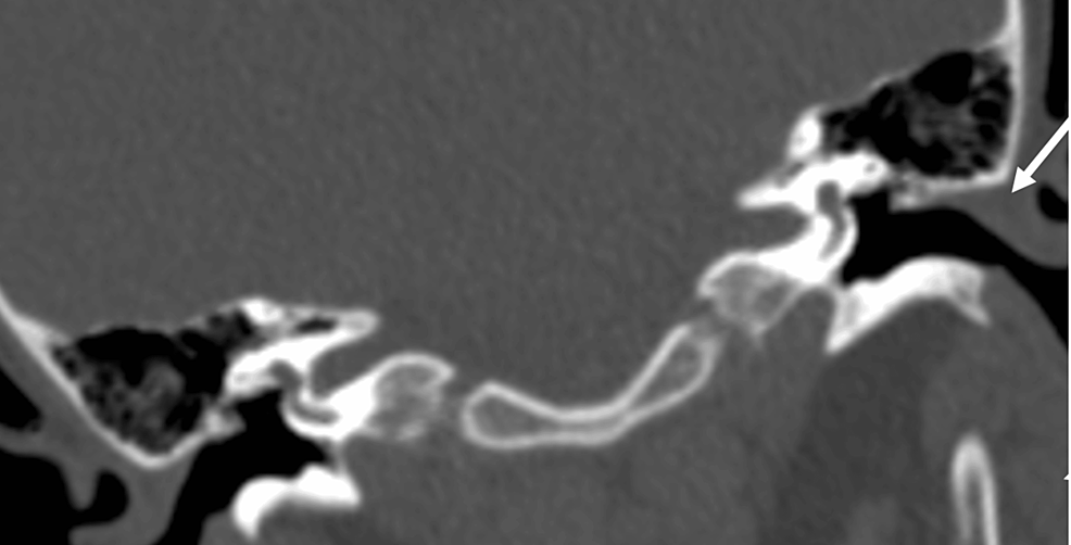 Cholesteatoma: Canalplasty for External Auditory Stenosis in a ...